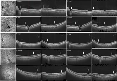 WF SS-OCTA for detecting diabetic retinopathy and evaluating the effect of photocoagulation on posterior vitreous detachment